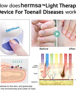 Hermsa™ light therapy device for toenail diseases