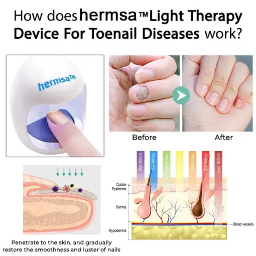 Hermsa™ light therapy device for toenail diseases