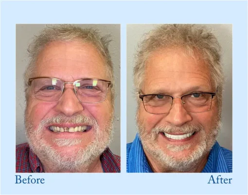HERMSA® 🦷Advanced Customized Full Denture Se