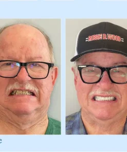 HERMSA® 🦷Advanced Customized Full Denture Se