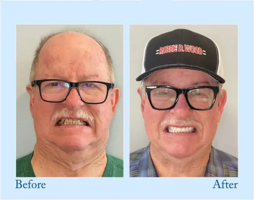 HERMSA® 🦷Advanced Customized Full Denture Se