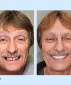 HERMSA® 🦷Advanced Customized Full Denture Se