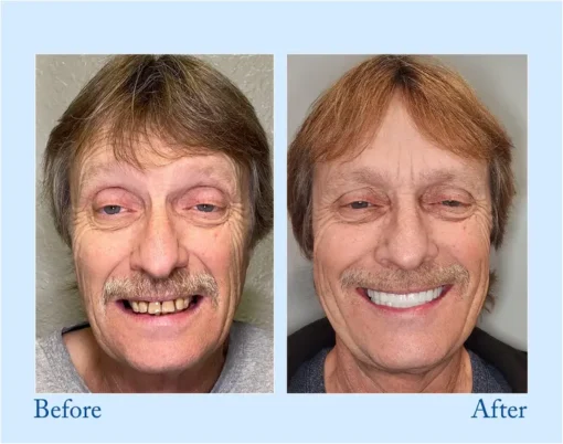 HERMSA® 🦷Advanced Customized Full Denture Se