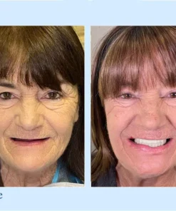 HERMSA® 🦷Advanced Customized Full Denture Se