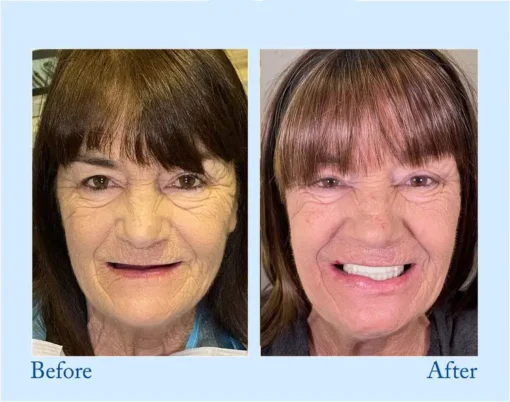 HERMSA® 🦷Advanced Customized Full Denture Se