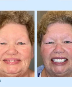 HERMSA® 🦷Advanced Customized Full Denture Se