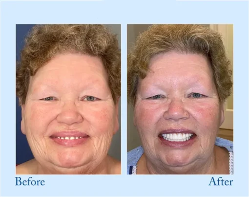 HERMSA® 🦷Advanced Customized Full Denture Se