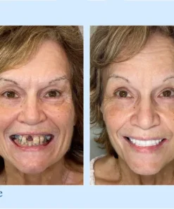 HERMSA® 🦷Advanced Customized Full Denture Se