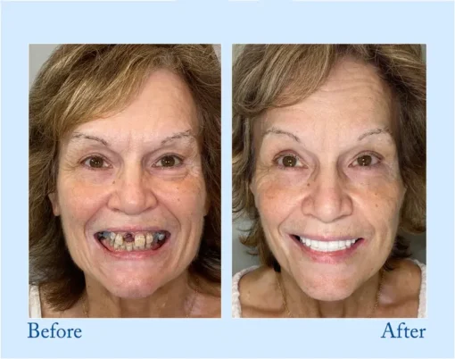 HERMSA® 🦷Advanced Customized Full Denture Se
