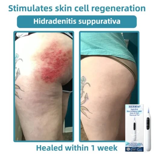 Hermsa® High-End Non-Invasive Laser Mole & Wart Removal Pen