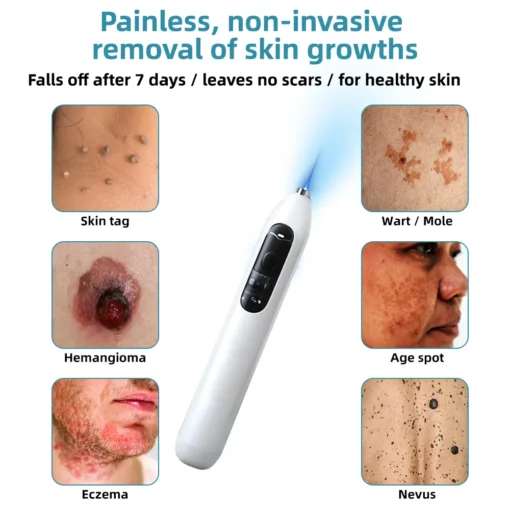Hermsa® High-End Non-Invasive Laser Mole & Wart Removal Pen