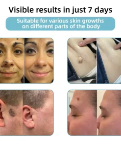 Hermsa® High-End Non-Invasive Laser Mole & Wart Removal Pen