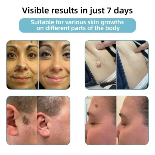 Hermsa® High-End Non-Invasive Laser Mole & Wart Removal Pen
