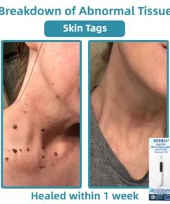 Hermsa® High-End Non-Invasive Laser Mole & Wart Removal Pen