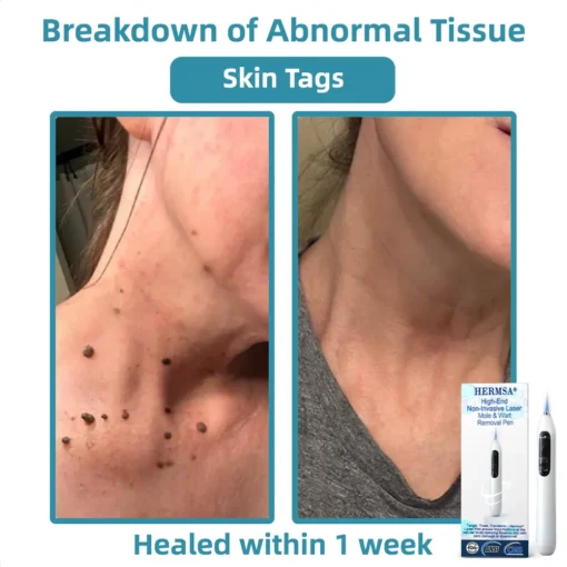 Hermsa® High-End Non-Invasive Laser Mole & Wart Removal Pen