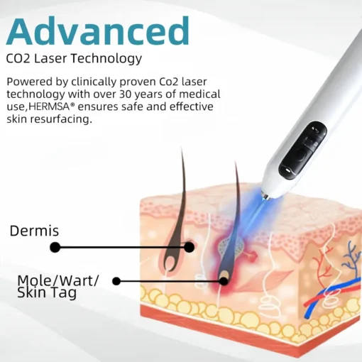 Hermsa® High-End Non-Invasive Laser Mole & Wart Removal Pen
