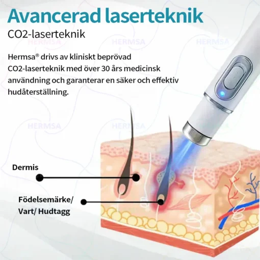 Hermsa® Non-Invasive Laser Pen - Mole and Wart Removal