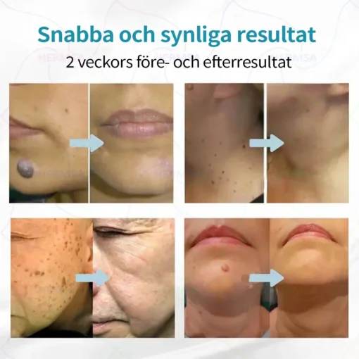 Hermsa® Non-Invasive Laser Pen - Mole and Wart Removal