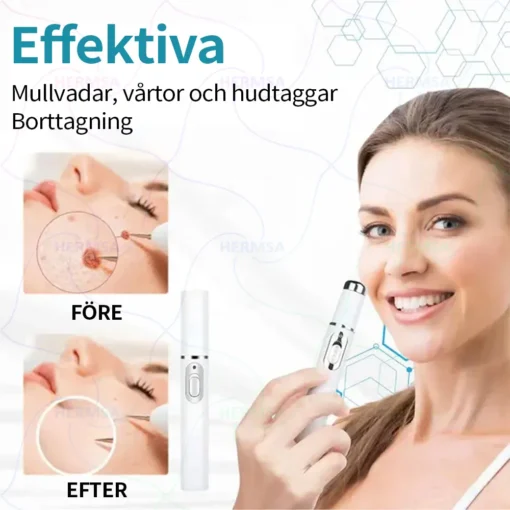 Hermsa® Non-Invasive Laser Pen - Mole and Wart Removal