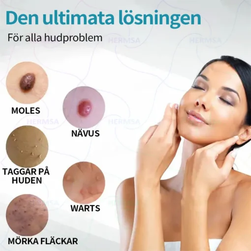 Hermsa® Non-Invasive Laser Pen - Mole and Wart Removal