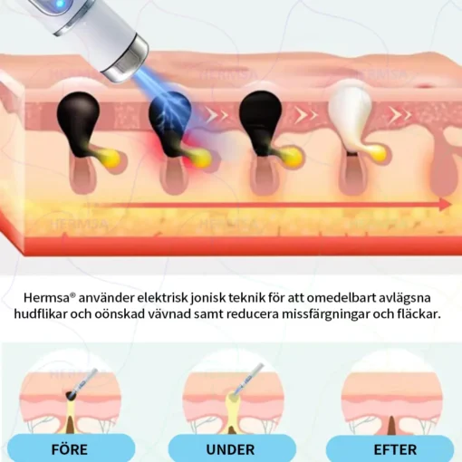 Hermsa® Non-Invasive Laser Pen - Mole and Wart Removal