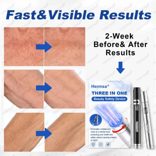 Hermsa® Multi-Functional Laser Pen Three In One Beauty Safety Device