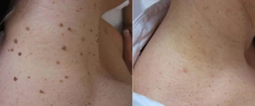 Hermsa® non-invasive laser pointer - mole and wart removal