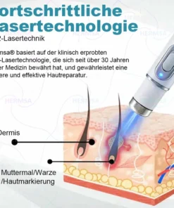 Hermsa® non-invasive laser pointer - mole and wart removal