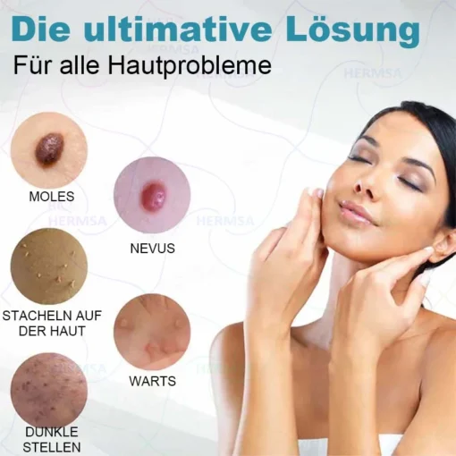 Hermsa® non-invasive laser pointer - mole and wart removal