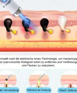 Hermsa® non-invasive laser pointer - mole and wart removal