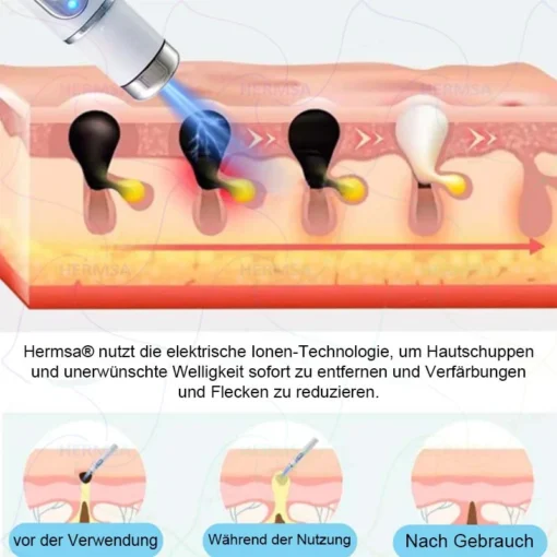 Hermsa® non-invasive laser pointer - mole and wart removal
