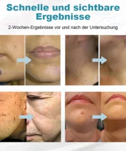Hermsa® non-invasive laser pointer - mole and wart removal