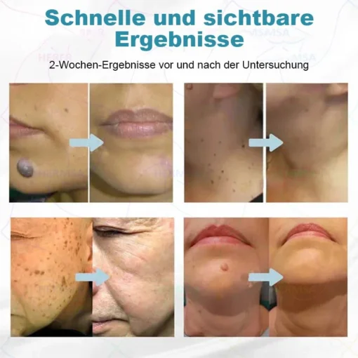 Hermsa® non-invasive laser pointer - mole and wart removal