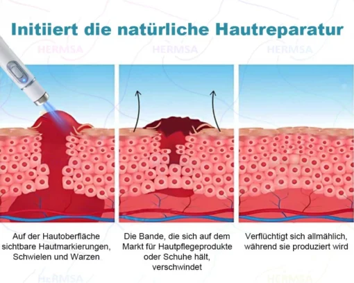 Hermsa® non-invasive laser pointer - mole and wart removal