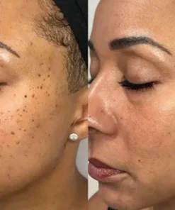 Hermsa® non-invasive laser pointer - mole and wart removal
