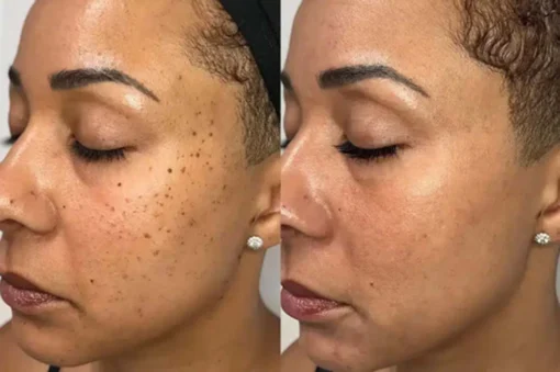 Hermsa® non-invasive laser pointer - mole and wart removal