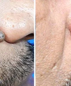 Hermsa® non-invasive laser pointer - mole and wart removal