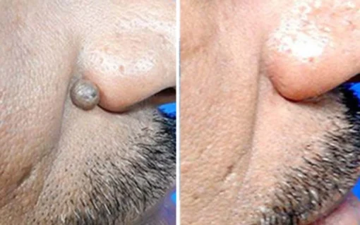 Hermsa® non-invasive laser pointer - mole and wart removal