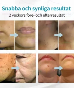 Hermsa® Ei-invasiivinen Laserkynä - Syntymämerkkien ja Syylien Poisto (Viimeinen päivä 80 ALE)