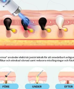 Hermsa® Ei-invasiivinen Laserkynä - Syntymämerkkien ja Syylien Poisto (Viimeinen päivä 80 ALE)